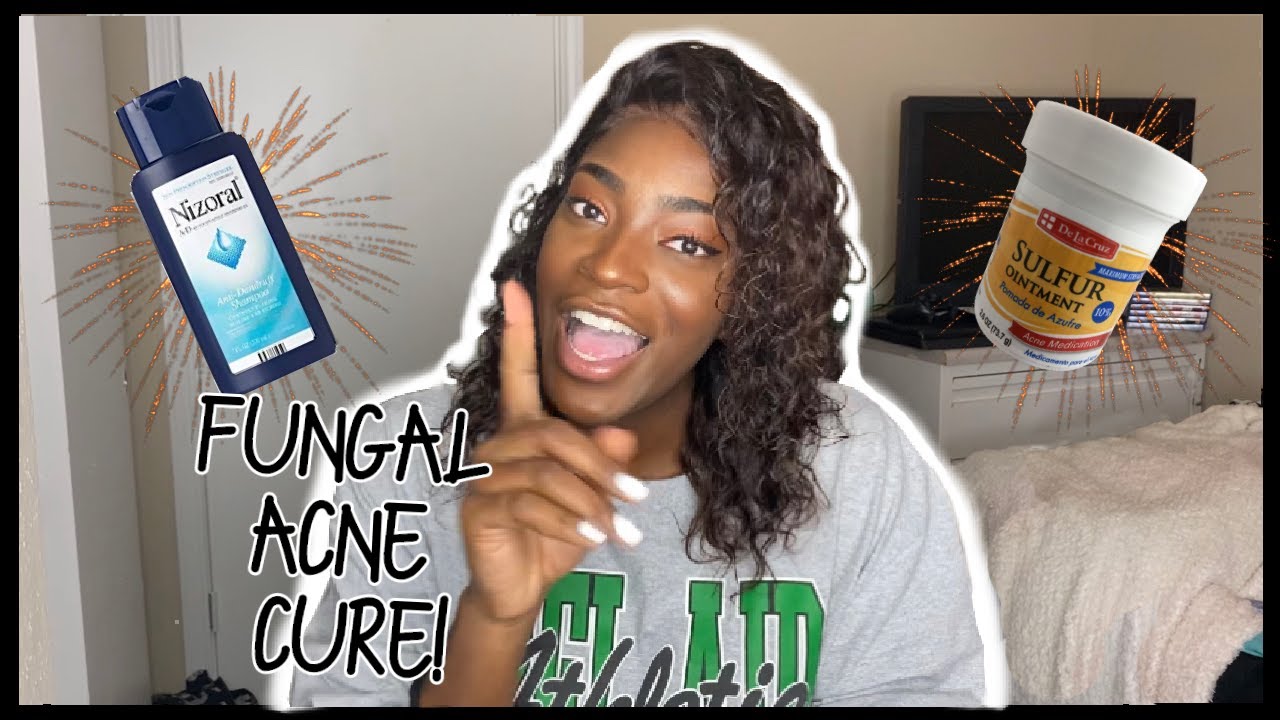 HOW TO PERMANENTLY GET RID OF FUNGAL ACNE & TEXTURED SKIN - YouTube
