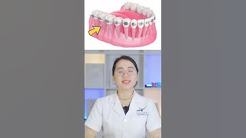 5 Lợi Ích Của Việc Niềng Răng Sớm | Tại Sao Nên Niềng Răng Từ Khi Còn Trẻ