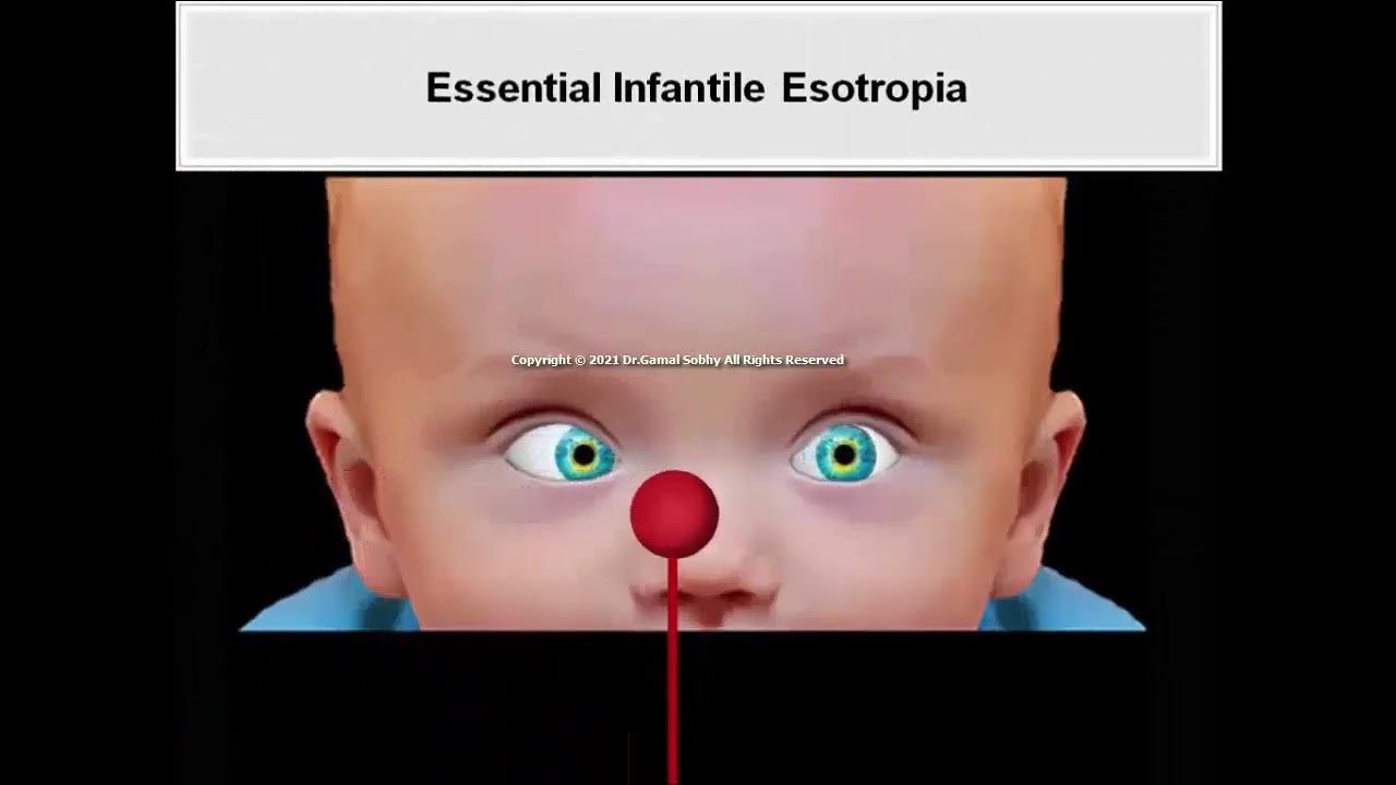 16 Esodeviations Animated Book Binocular Vision and Ocular Motility