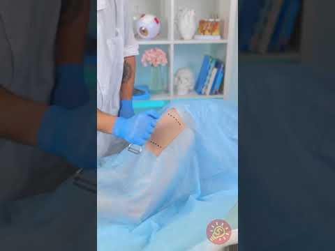 هكذا تعمل عمليات زراعة الجلد في الواقع