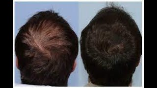 علاج الصلع الوراثي و تساقط الشعر | Baldness cure | اهم الوصفات لعلاج الثعلبة