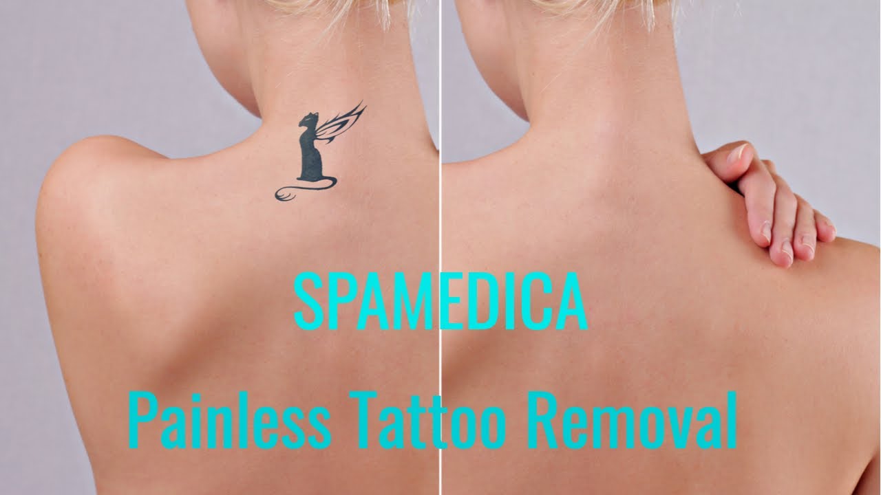 SpaMedica's Dr. Mulholland talks about Painless Laser Tattoo Removal