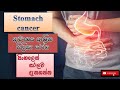 Stomach cancer/ආමාශය ආශ්‍රිත පිළිකා රෝග/causes/how it happens/treatment/sinhala/how to prevent