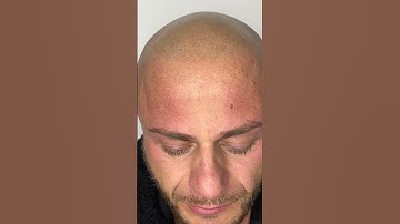 What to Expect First session Scalp Micropigmentation