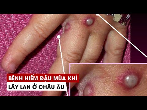 Video Bệnh hiếm đậu mùa khỉ xuất hiện ở châu Âu, lan đến Mỹ - youtube