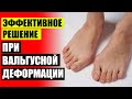 💊 ВАЛЬГУС СТОПЫ КАК ЛЕЧИТЬ 🎯 ВОСПАЛЕНИЕ КОСТОЧКИ БОЛЬШОГО ПАЛЬЦА НА НОГЕ