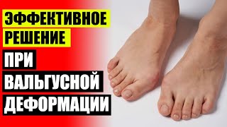💊 ВАЛЬГУС СТОПЫ КАК ЛЕЧИТЬ 🎯 ВОСПАЛЕНИЕ КОСТОЧКИ БОЛЬШОГО ПАЛЬЦА НА НОГЕ