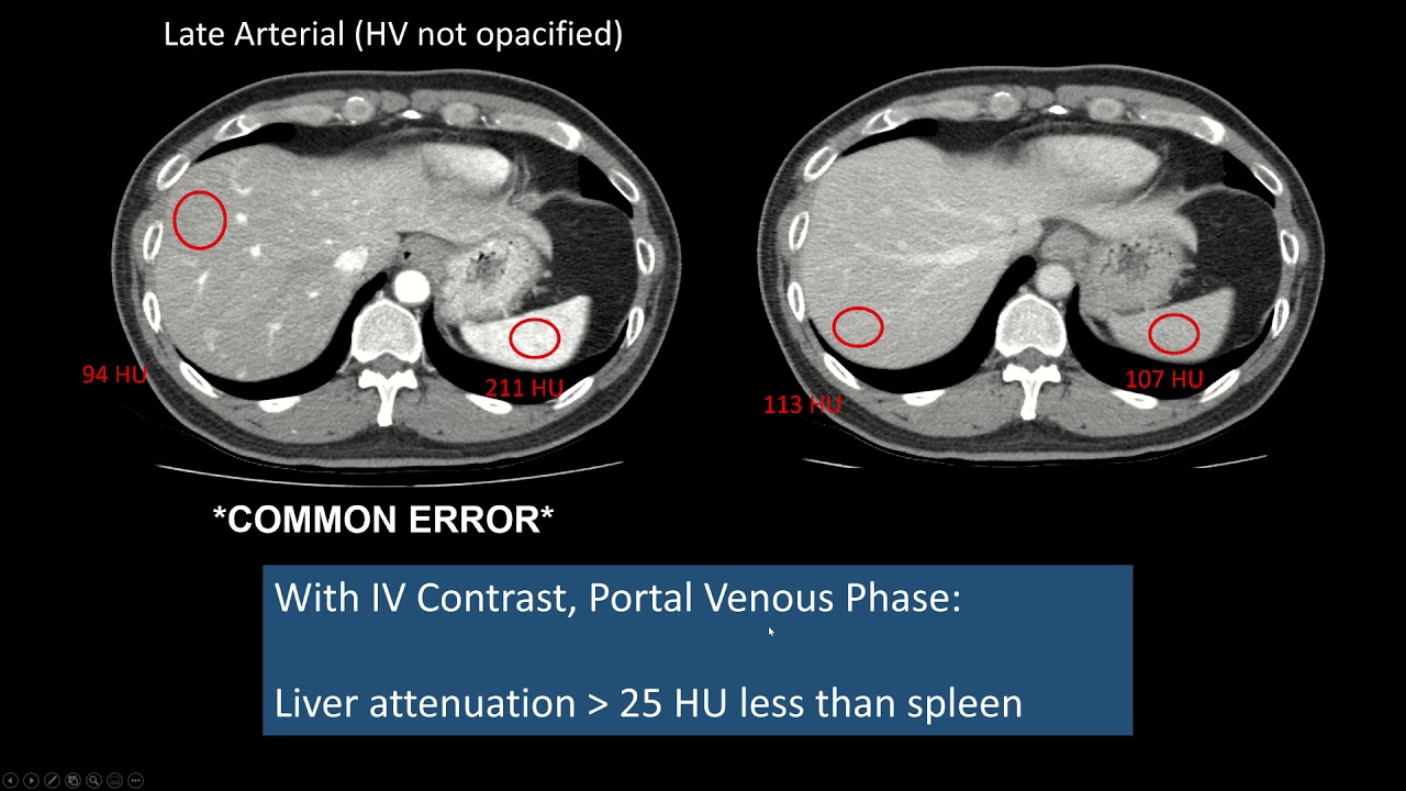 Fatty Liver Mri