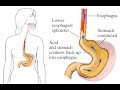 Gastroesophageal Reflux Disease (GERD)