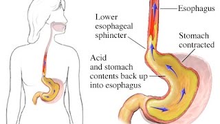 Gastroesophageal Reflux Disease (GERD)