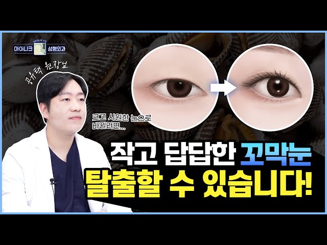“작고 아담한 꼬막눈을 크고 시원하게 만들 수 있나요?” 답답한 인상을 만드는 꼬막눈 개선방법은?│공유택 원장님이 알려주는 꼬막눈 수술!