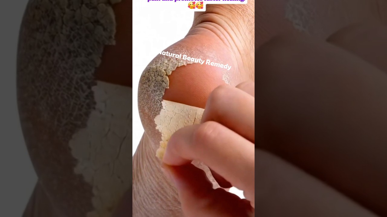 “Cracked heels? Fix them fast with this powerful DIY foot remedy 👣✨ #CrackedHeels #DryFeet #shorts