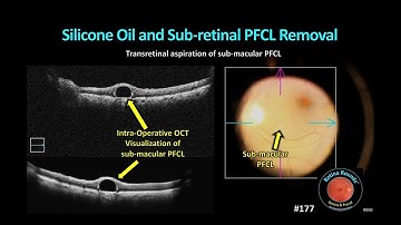 RetinaRounds™ 177: Verwijdering van siliconenolie en subretinale PFCL