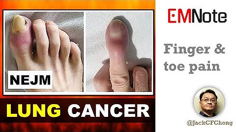 Acrometastasis of lung adenocarcinoma