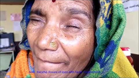 What is Blepharospasm ? clinical video !