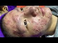 Treatment of acne tablets pustules and blackheads 358  loan nguyen
