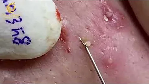 Come curare acne purulenta?
