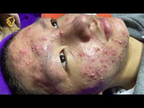 Vídeo: Es Donen Nom A Causes Inesperades D’acne
