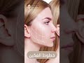 تجميل الرقبه مع الدكتوره ريم الخاطر 