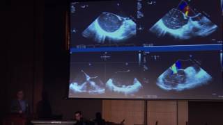 Transition, Transfer and Life-long Care - Dr. Leigh Reardon | 2017 UCLA ACHD Symposium
