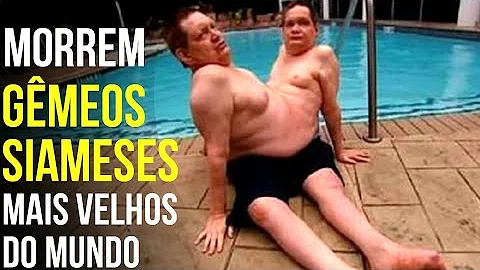 O que causa gêmeas siamesas?