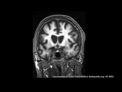 Huntington&rsquo;s Disease