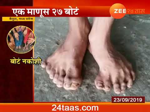 Madhya Pradesh | Family Members Having More Numbes Of Fingers Than Normal zee 24 taas marathi