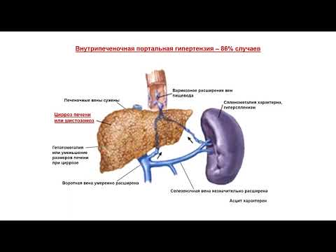 УЗИ. Доктор Иогансен. Выпуск 15. Портальная гипертензия. Часть 1.