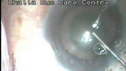 Dilatation of Pupil by stretching with Y