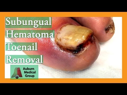 Subungual Hematoma - American Osteopathic College of Dermatology (AOCD)