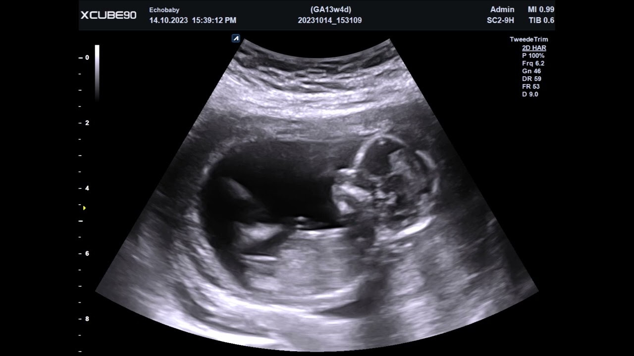 13 Weken Zwanger Geslachtsbepaling Meisjes