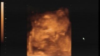 Gravimagem 16232 Ultrom Morfológico 4 D Em Gravidez Com 36 Semanas