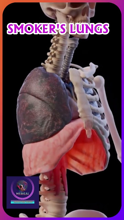 What Smoking Really Does to Your Lungs – Medical Animation