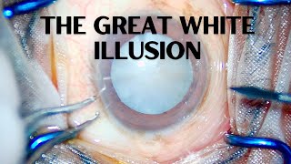 The Great White Illusion | Cataract Surgery