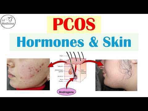PCOS & Your Skin: 4 Signs Your Hormones Are Out of Control