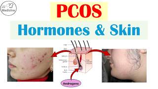 PCOS & Your Skin: 4 Signs Your Hormones Are Out of Control