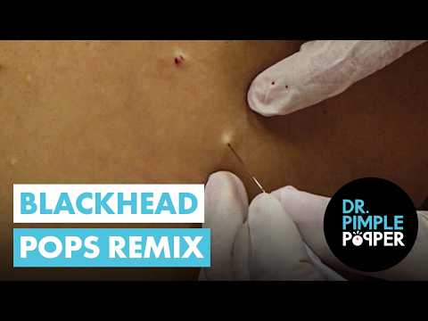 Can’t Look Away! Blackhead Pops (remix)