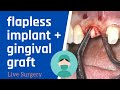 Flapless dental implant surgery with connective tissue graft  live