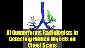 AI Outperforms Radiologists in Detecting Hidden Objects on Chest Scans