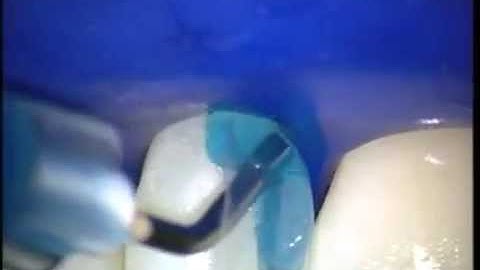 Bioclear - Peg Lateral