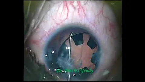 Morcher Ring in traumatic Aniridia with Cataract