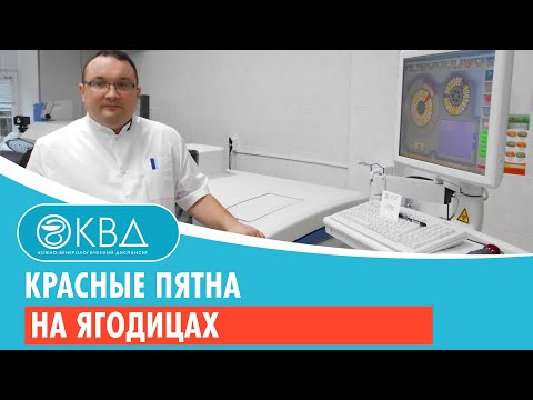 Красные пятна на ягодицах. Клинический случай №139