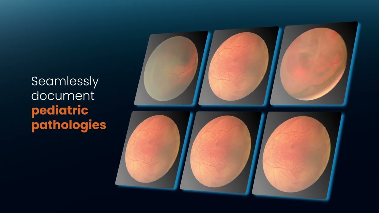 Neo - Pediatric widefield retinal imaging for ROP screening