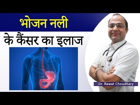 एसोफाजाल कैंसर | भोजन नली का कैंसर | Esophageal Cancer | Esophageal Cancer Best Treatment