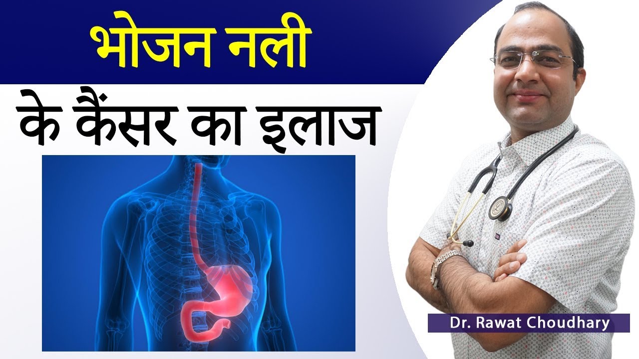 एसोफाजाल कैंसर भोजन नली का कैंसर Esophageal Cancer