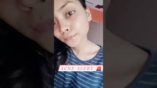 My Acne Journey Acnescars Acne Transformation Skincare