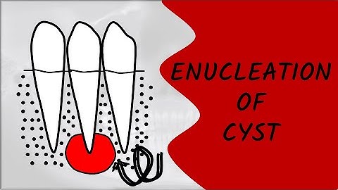 ENUCLEATION OF CYST || ORAL SURGERY || ORAL MEDICINE AND PATHOLOGY || DENTAL CLASSES BY DENTAL CAFE