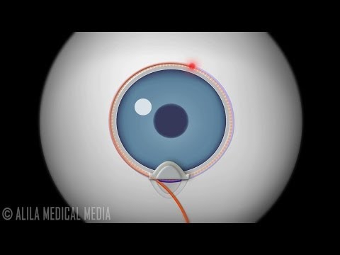 Canaloplasty Procedure for Glaucoma, Animation.