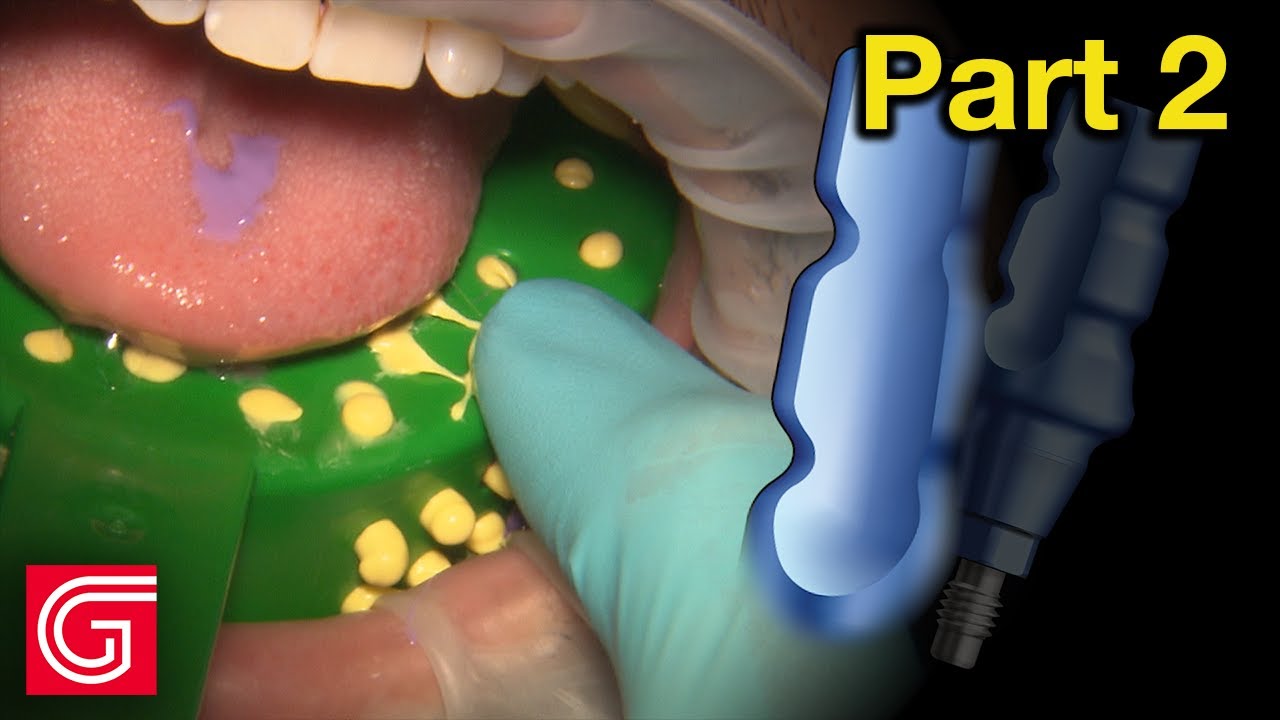 HOW TO Take Closed Tray Implant Impression for Tooth 19 YouTube