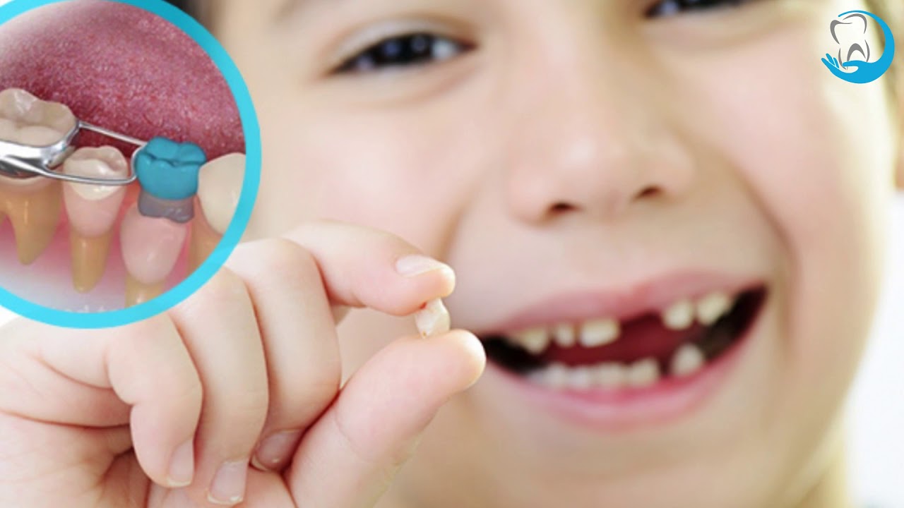 Çürümüş Süd Dişləri Çıxarılmalıdırmı ?- VALİDEYİNLƏR DİQQƏT EDİN